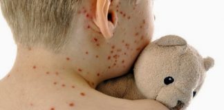 Organizația Mondială a Sănătății cere României și Italiei să ia măsuri împotriva epidemiei de rujeolă