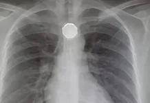 Bărbat din Italia, ajunge la Urgențe crezând că are un infarct. Medicii găsesc un dop metalic de la o sticlă în esofagul său 1