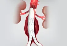 EVAR: cum se tratează anevrismul de aortă fără operație deschisă – ghid pentru românii din Italia Stent graft implantat prin EVAR într-un anevrism de aortă abdominală