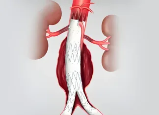 EVAR: cum se tratează anevrismul de aortă fără operație deschisă – ghid pentru românii din Italia Stent graft implantat prin EVAR într-un anevrism de aortă abdominală