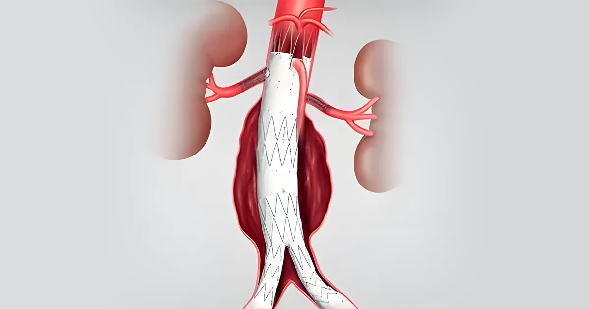 Stent graft implantat prin EVAR într-un anevrism de aortă abdominală